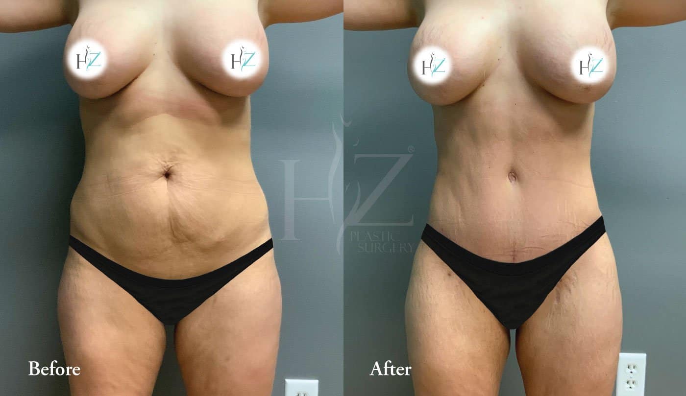 Tummy Tuck Turkey Before And After46