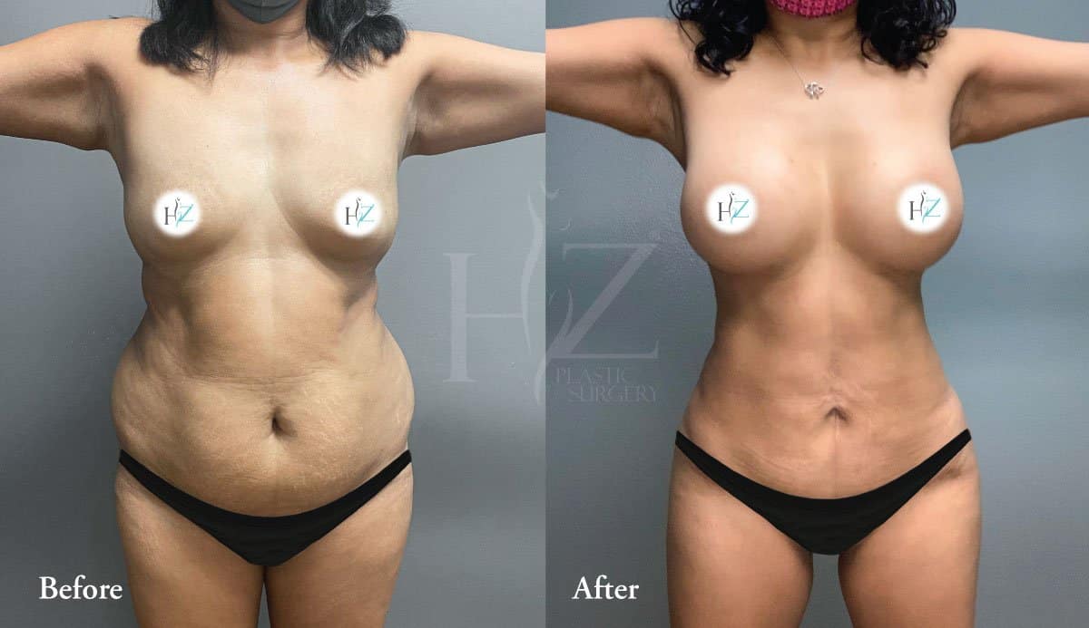 Tummy Tuck Turkey Before And After47