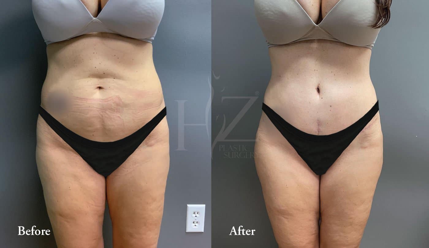 Tummy Tuck Turkey Before And After48