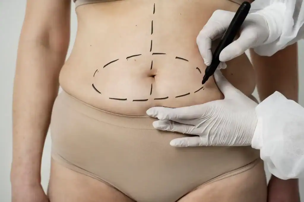Mommy Makeover 34 Tummy Tuck turkey in istanbul