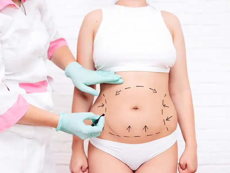 Mommy Makeover 35 annelik estetigi2