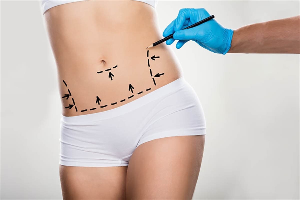 FDL Tummy Tuck 37 turkiye de karin germe Ameliyat Fiyati