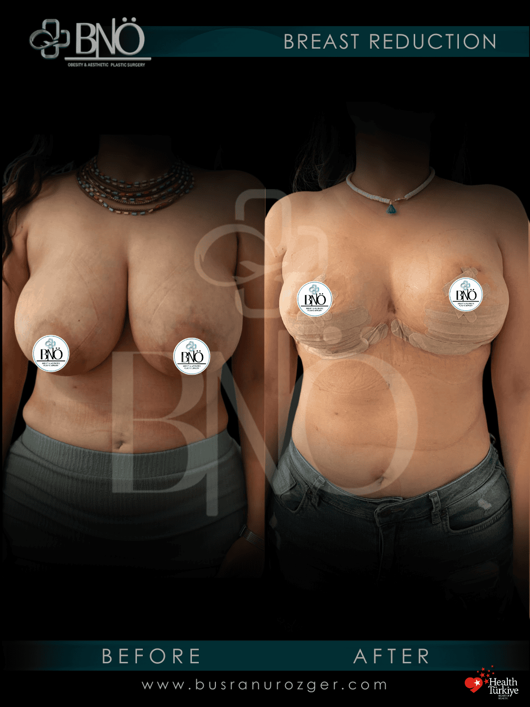 Breast Reduction 26 1