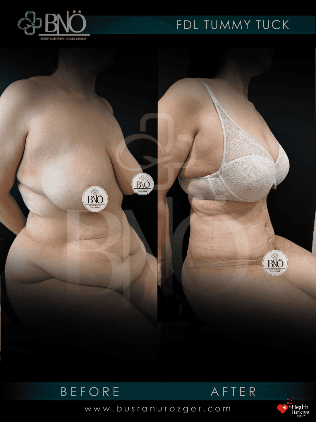 FDL Tummy Tuck 26 100