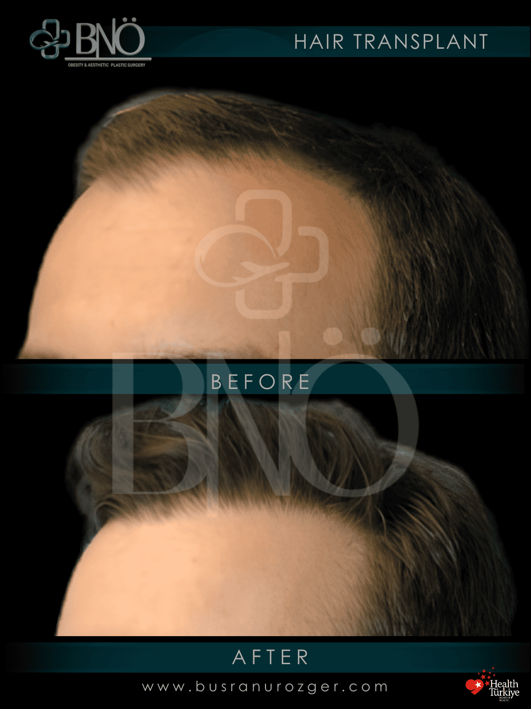 DHI Hair Transplant 31 126