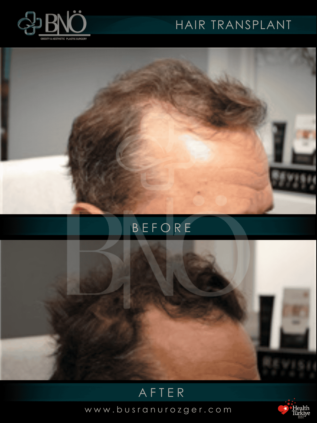 DHI Hair Transplant 30 127