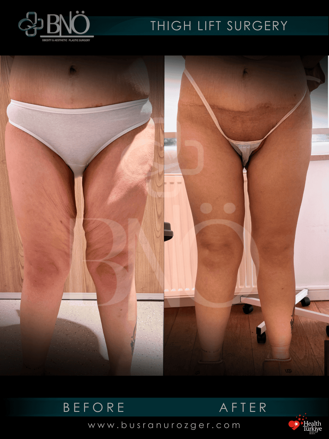 Thigh Lift 29 159