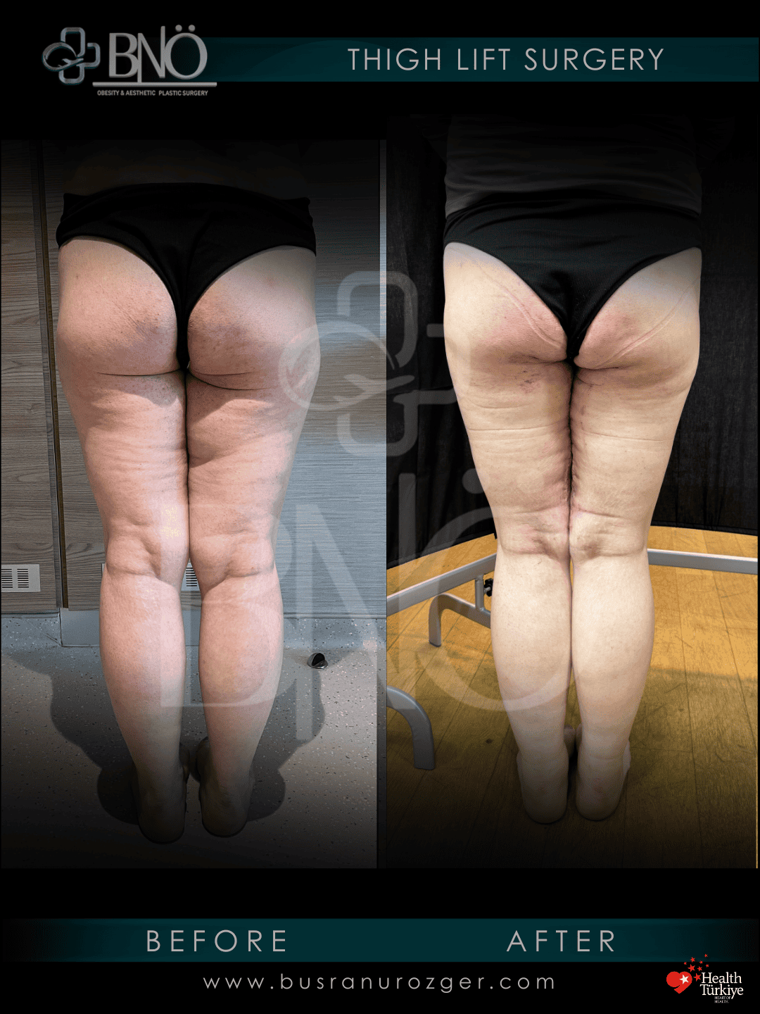 Thigh Lift 30 176
