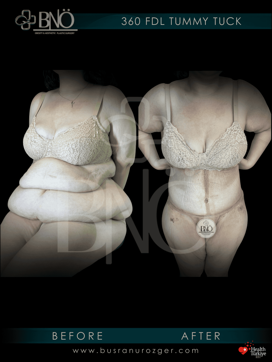 FDL Tummy Tuck 29 220