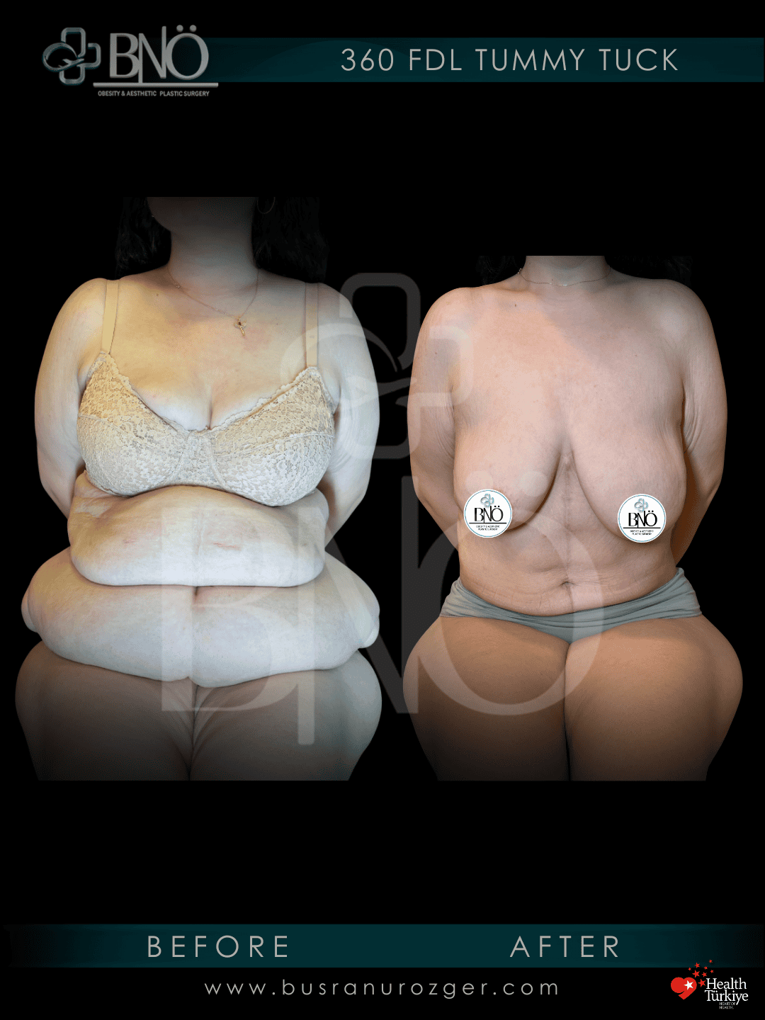 FDL Tummy Tuck 30 223