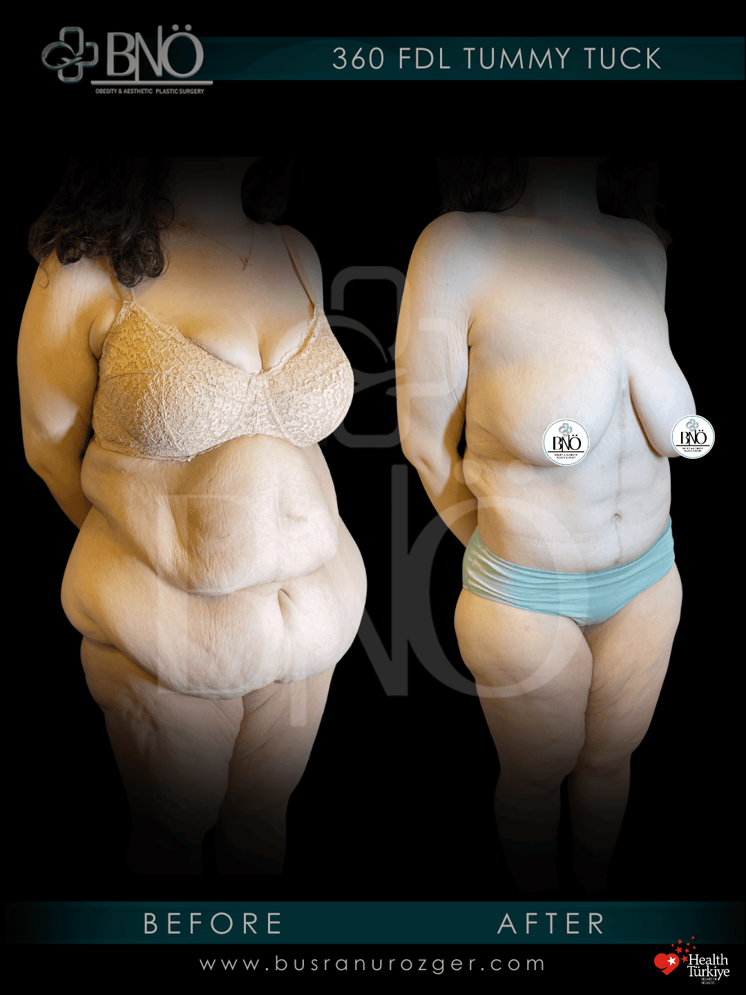 FDL Tummy Tuck 31 225
