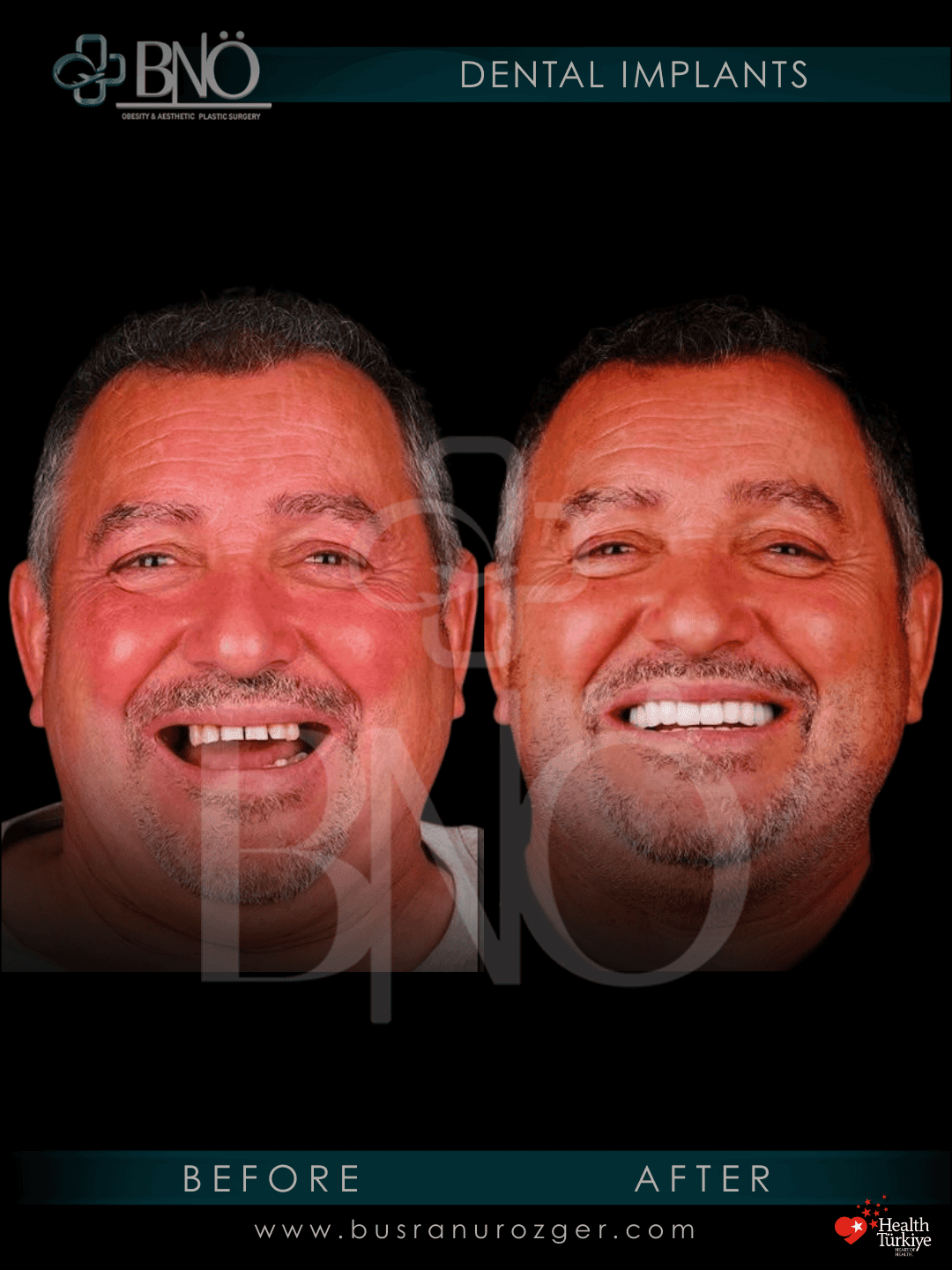 Dental Implants 28 230