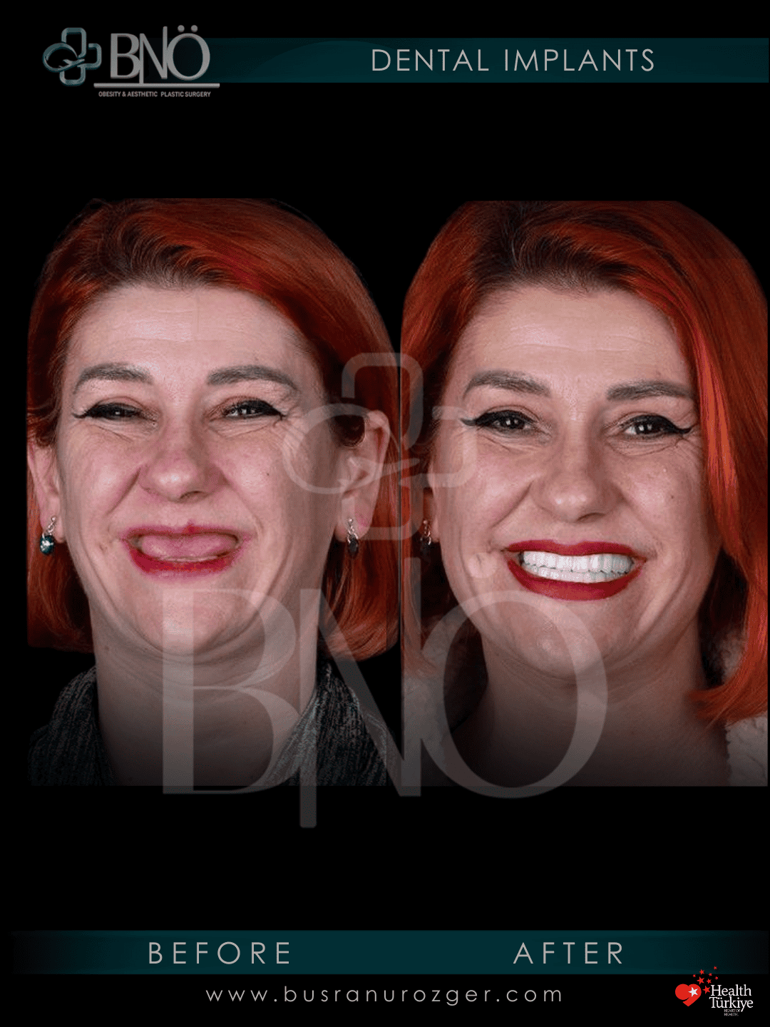 Dental Implants 26 231