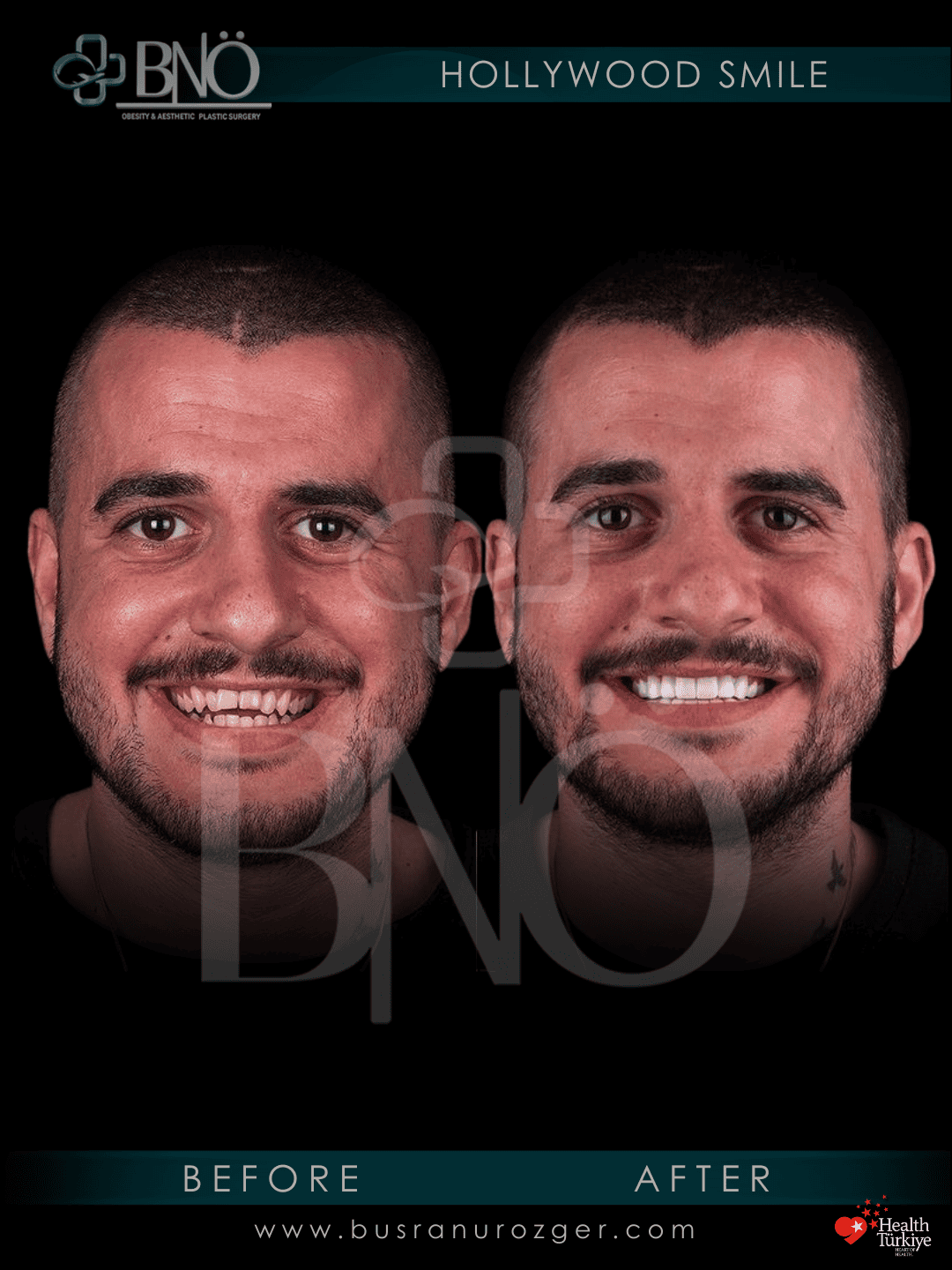 Hollywood Smile 26 233