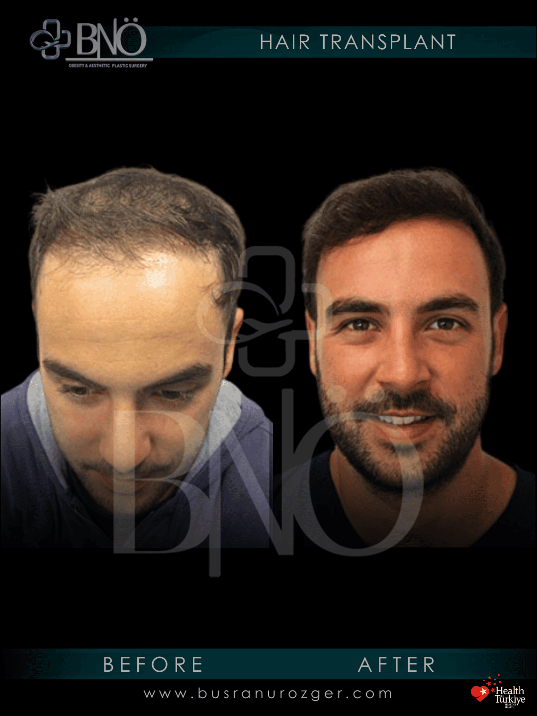 DHI Hair Transplant 26 235