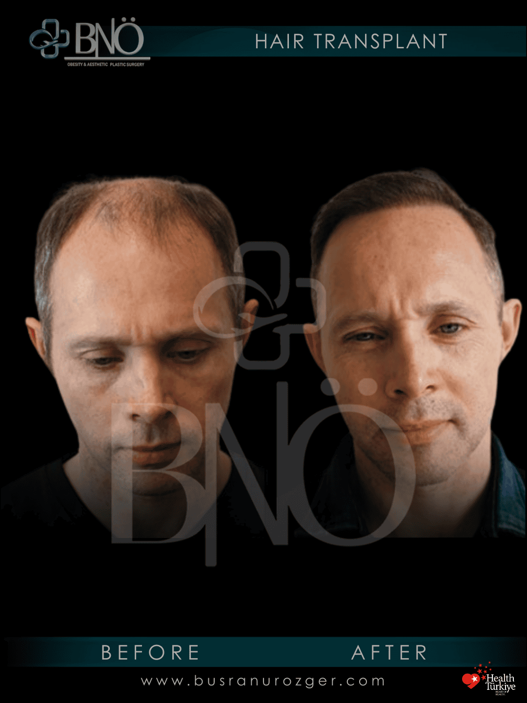 DHI Hair Transplant 27 236