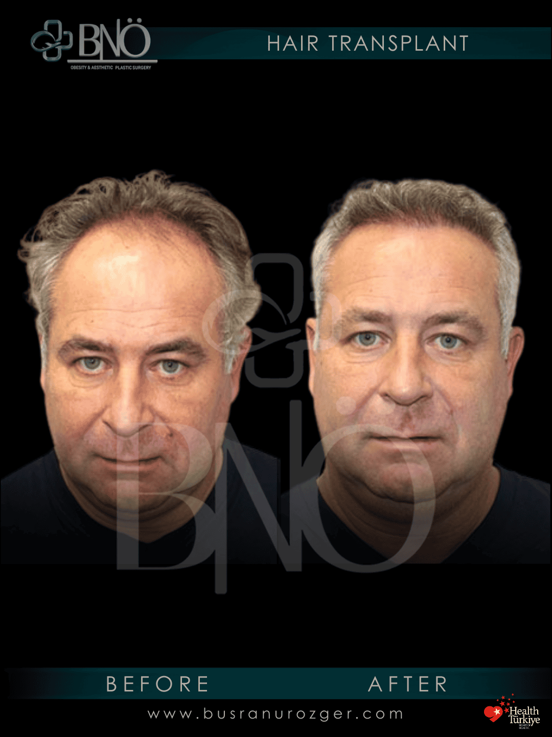 DHI Hair Transplant 28 237