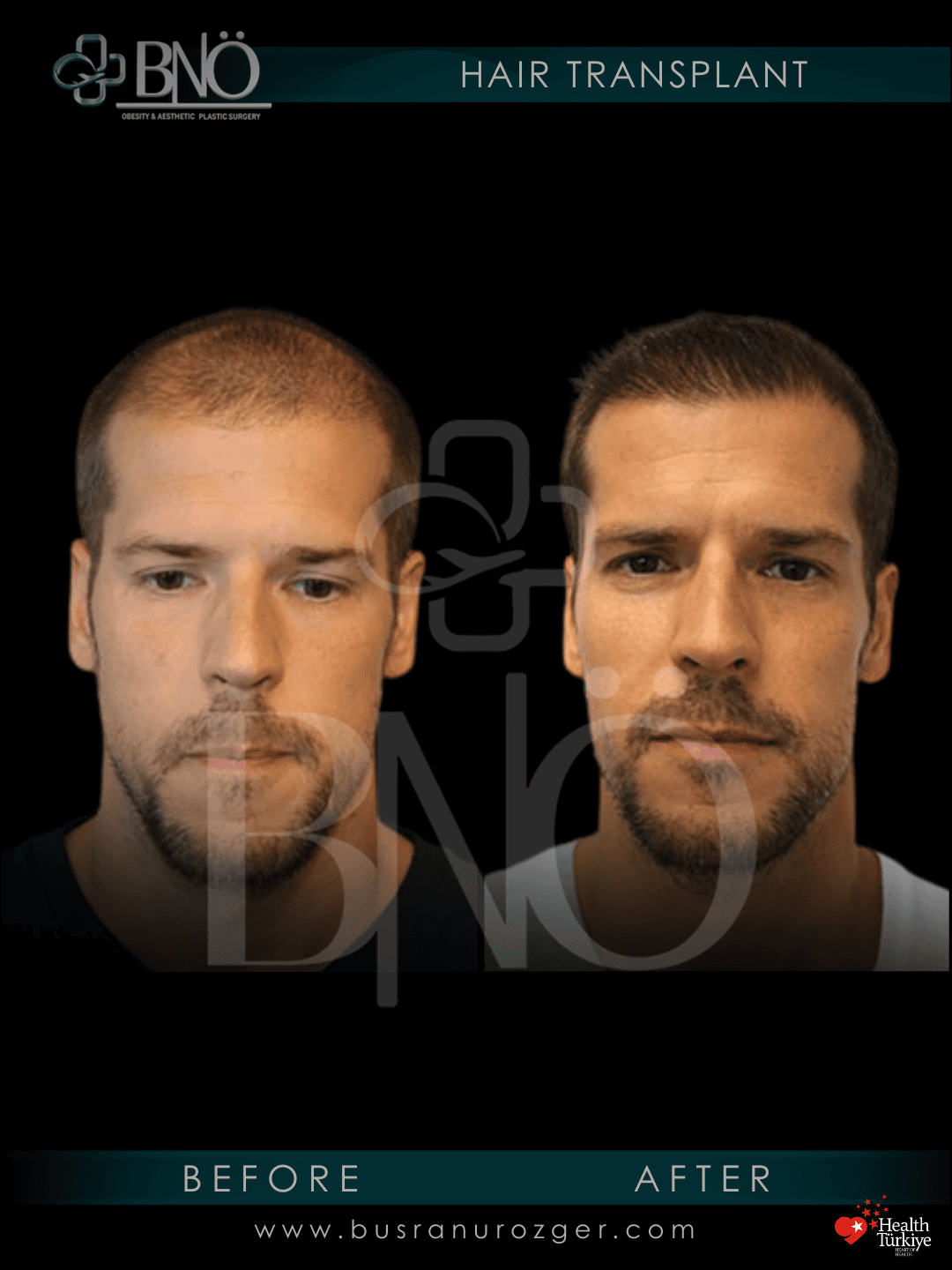 DHI Hair Transplant 29 238