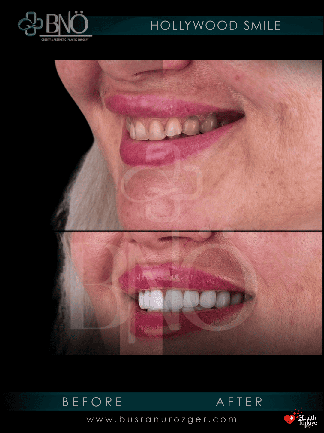 Hollywood Smile 28 241