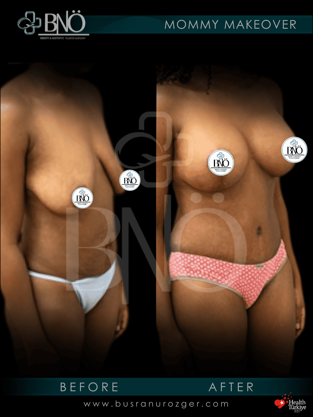 Mommy Makeover 31 32