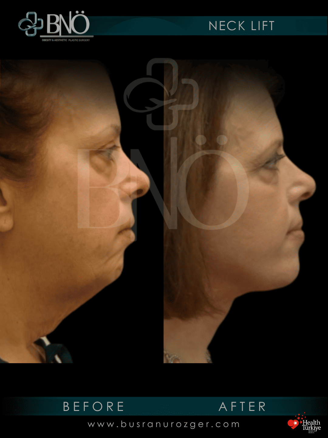 Neck Lift 31 38