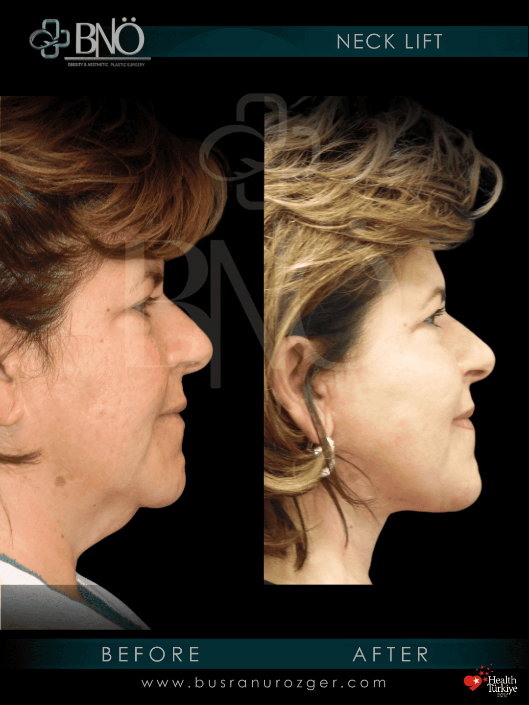 Neck Lift 30 39