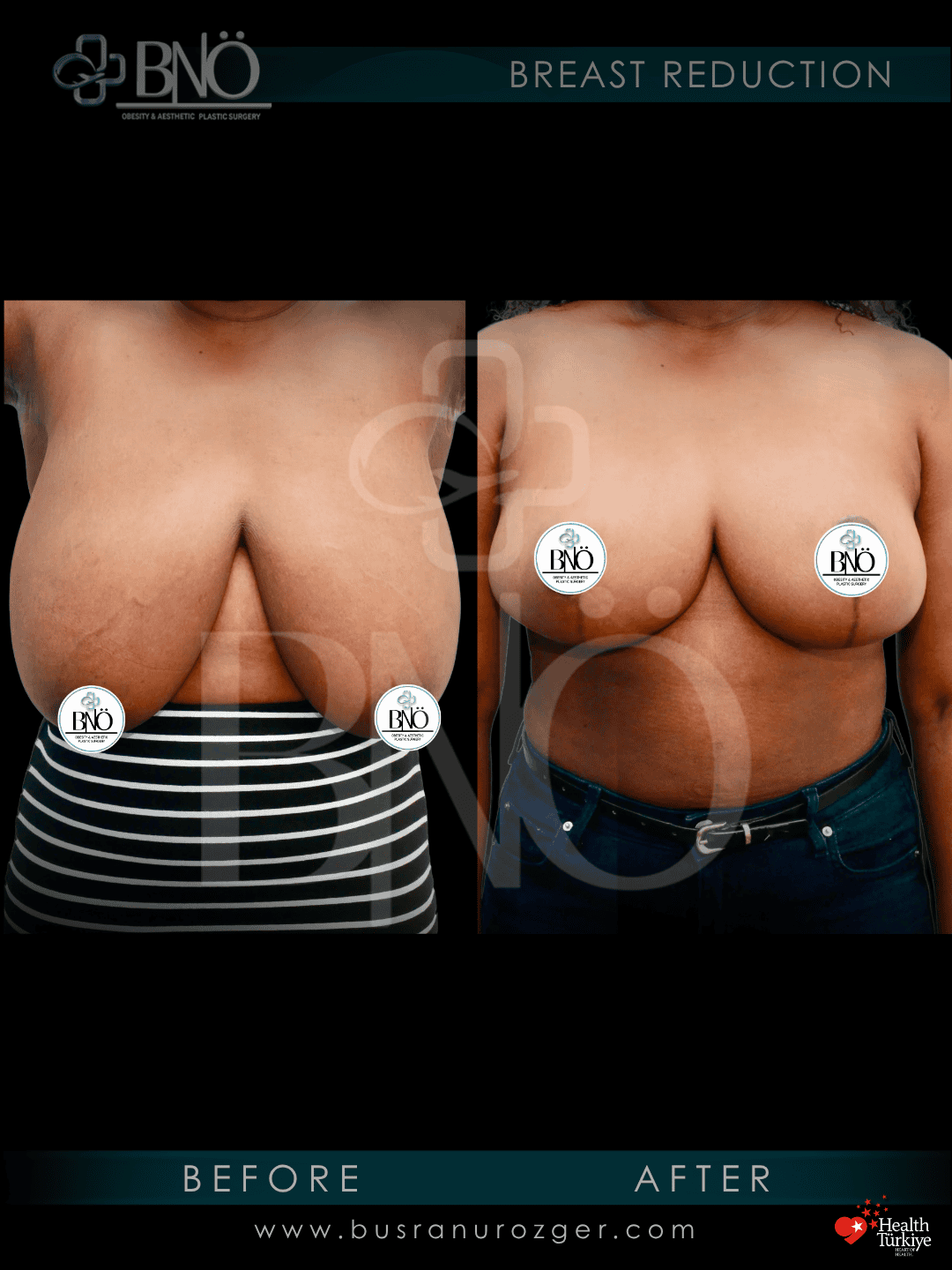 Breast Reduction 27 4 1