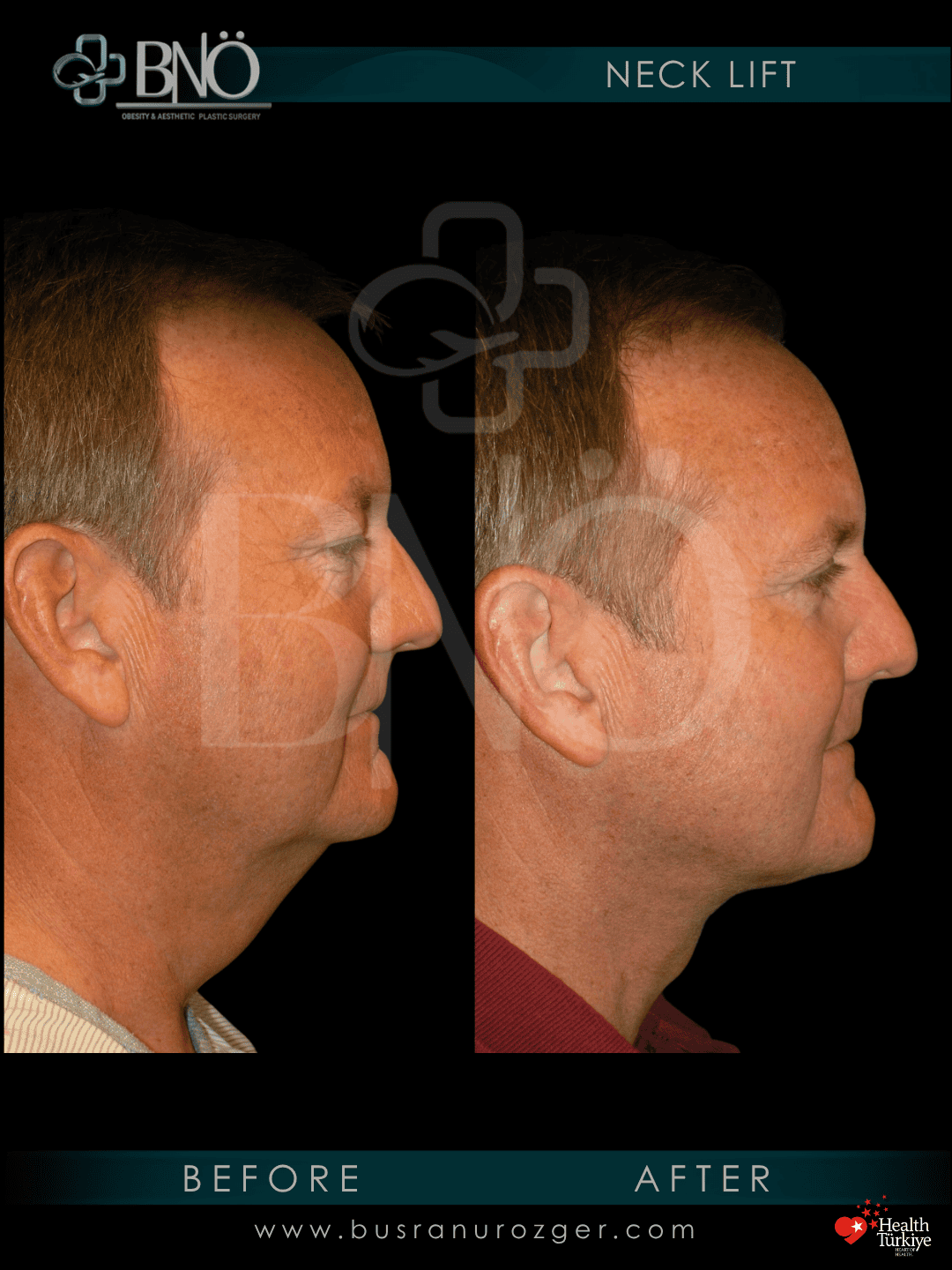 Neck Lift 29 40