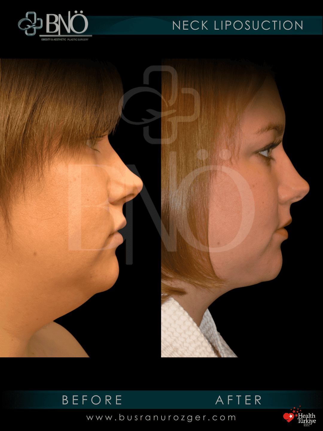 Neck Lift 27 42 1