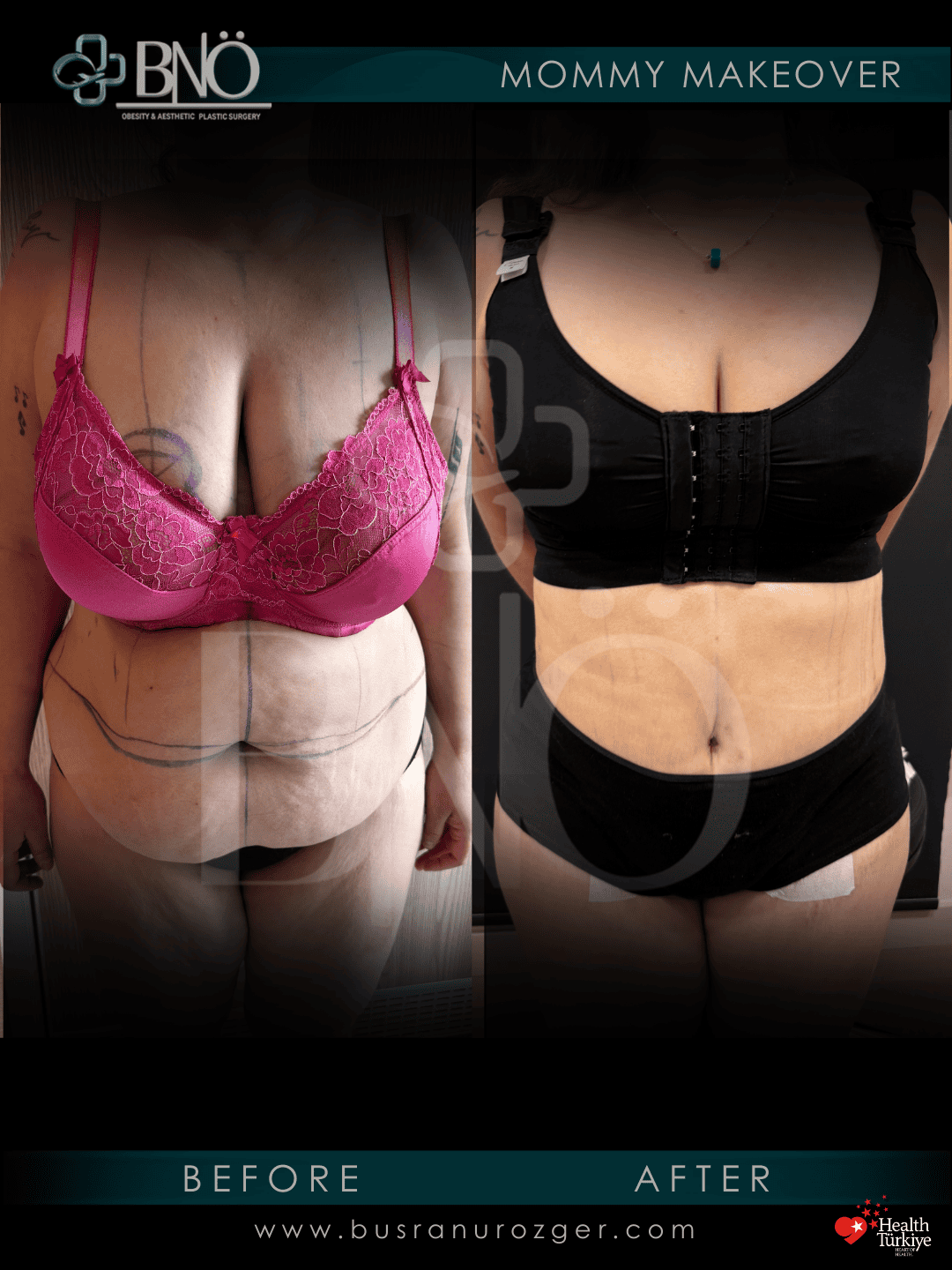 Mommy Makeover 28 90