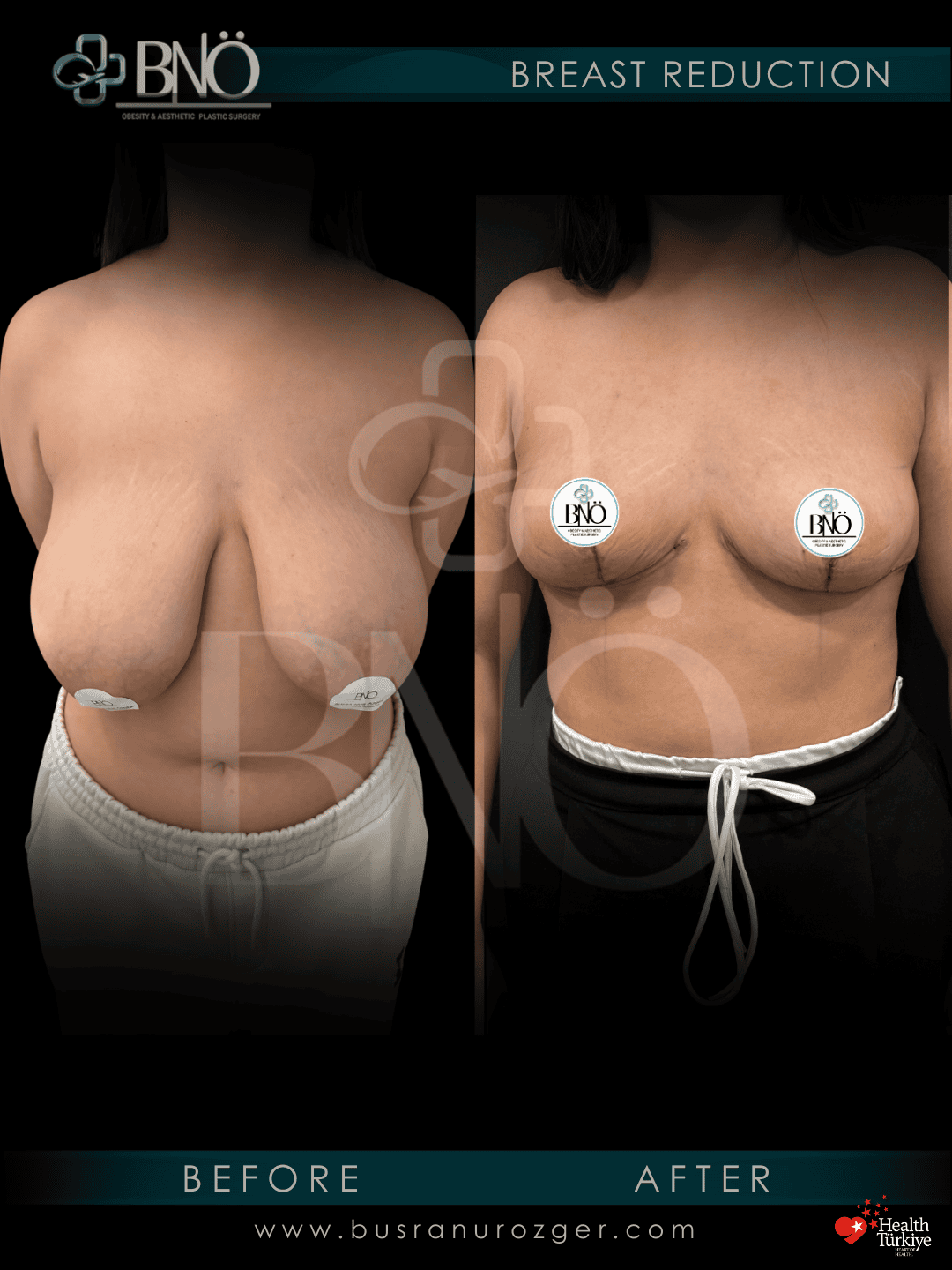 Breast Reduction 30 94 1