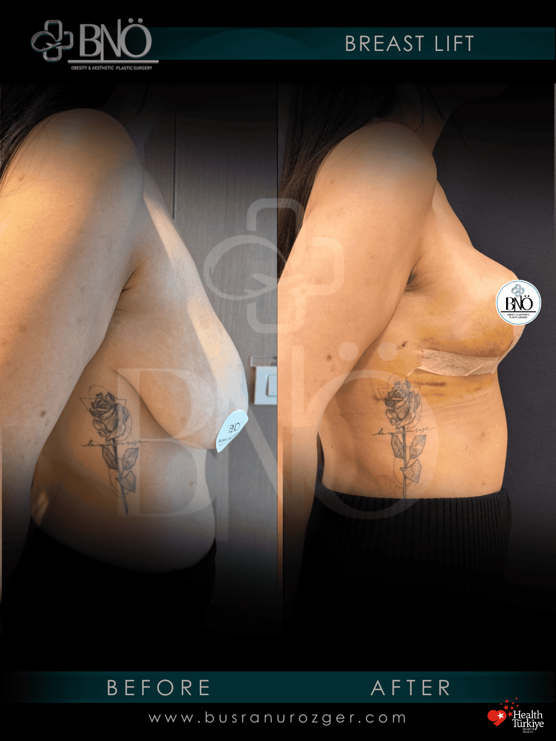 Breast Lift 26 99