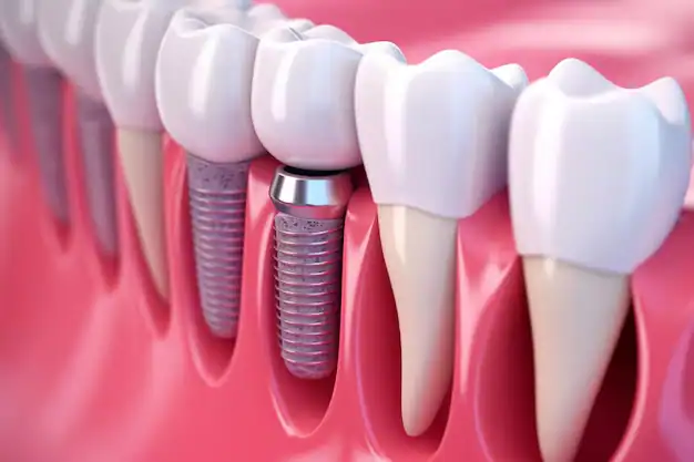 Dental Implants 35 Dental Implants price turkey