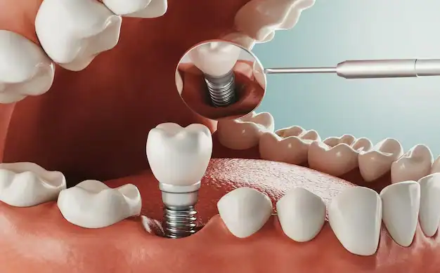 Dental Implants 33 Dental Implants turkey cost