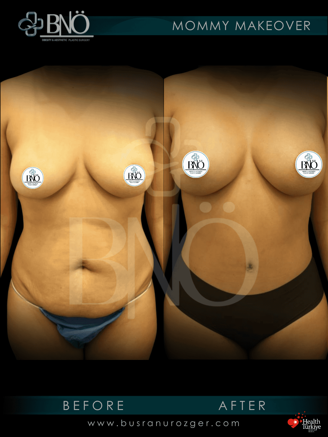 Mommy Makeover 29 FF