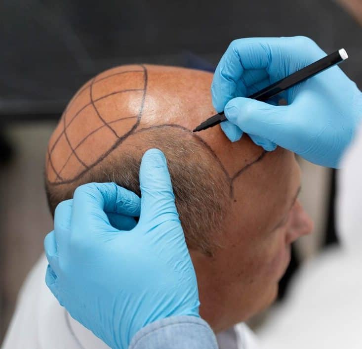 DHI Hair Transplant 38 Hair Transplant Turkey price