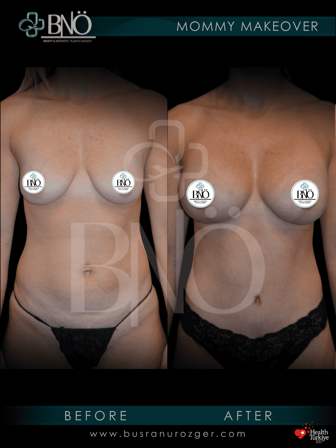 Mommy Makeover 30 JHY