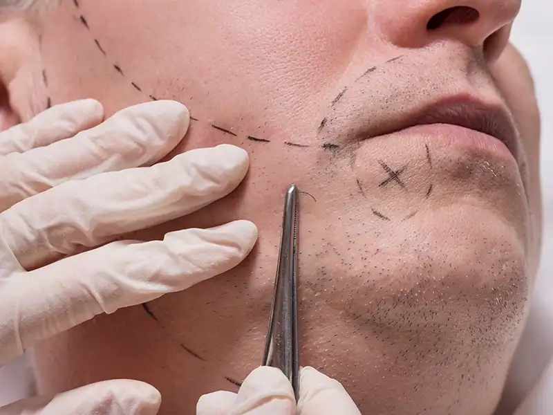 Who May Be a Good Candidate for Beard Transplant