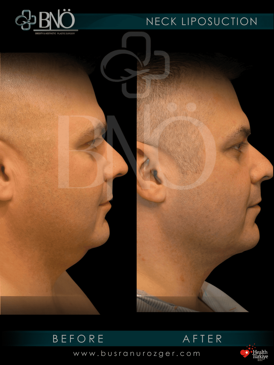 Neck Lift 26 akarsu calisma 2