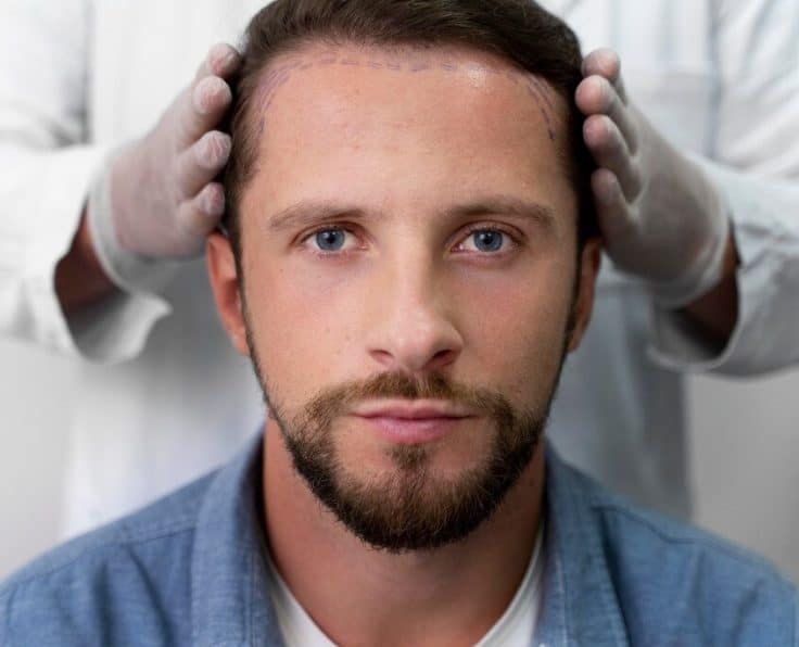 dhi-hair-transplant-in-turkey