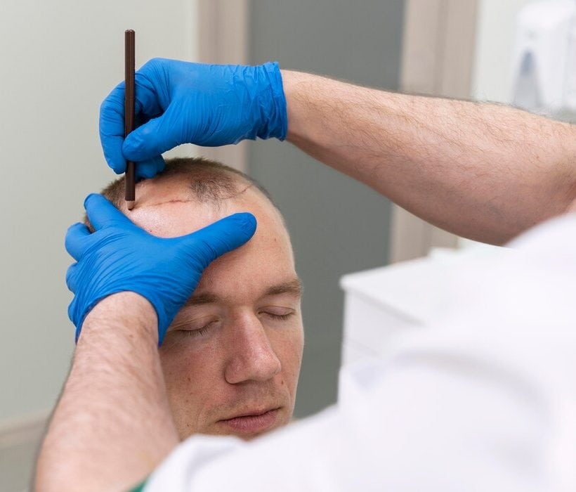 DHI Hair Transplant 36 hair transplant clinic turkey