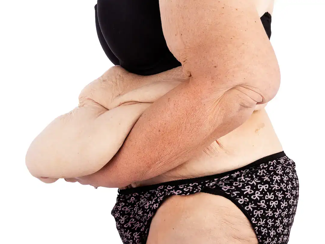 post bariatrik turkey cost