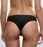 Does BBL Surgery Provide Permanent Results