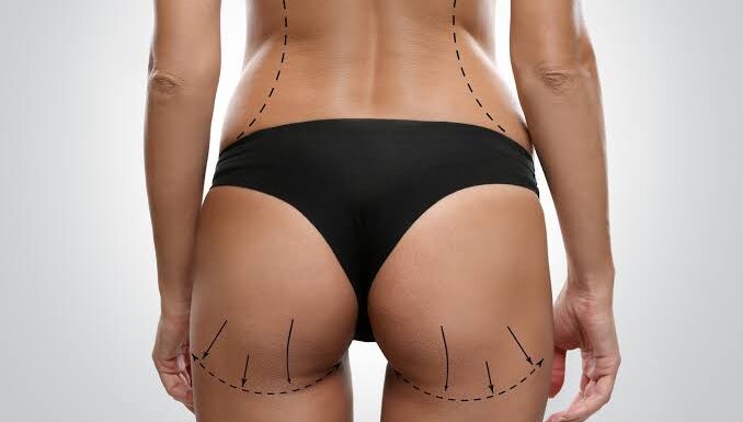 Does BBL Surgery Provide Permanent Results