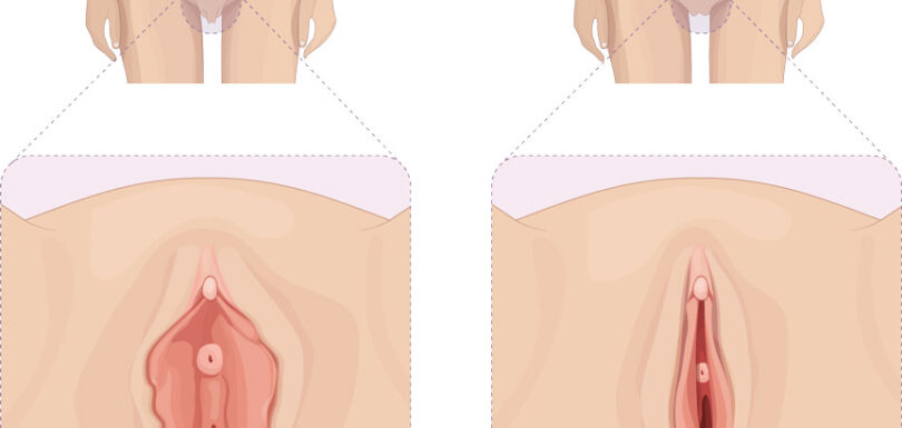 MaDan Labiplasty Procedure
