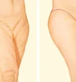 What is Thigh Lift Surgery Who is it suitable for