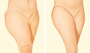 What is Thigh Lift Surgery Who is it suitable for