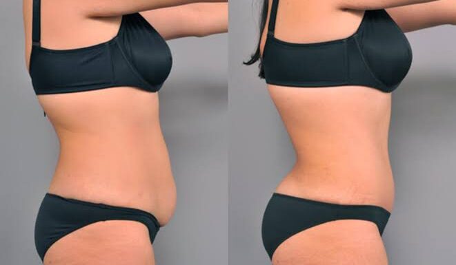 What is the recovery process like after a tummy tuck