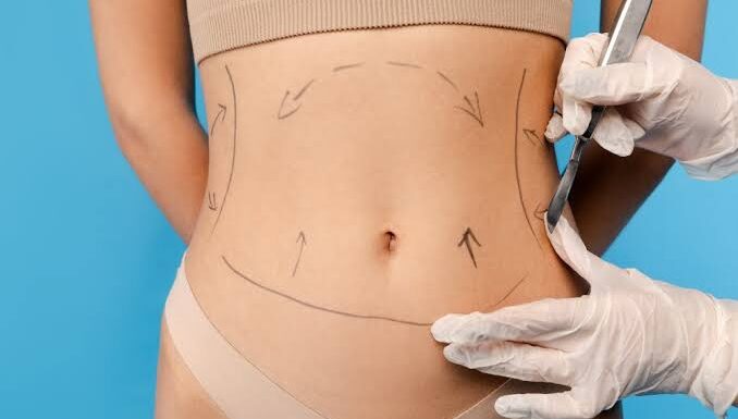 Which areas of fat can be removed with liposuction